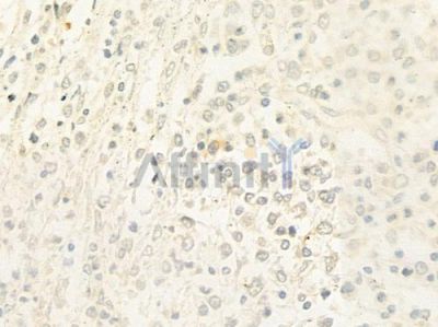 CD72 Antibody - DF7910 at 1/100 staining human Hodgkin lymphoma by IHC-P.
