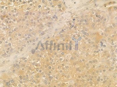 APOC3 Antibody - DF8054 at 1/100 staining human hepatocellular carcinoma by IHC-P.