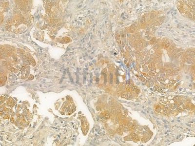 MAGE 1 Antibody - DF8082 at 1/100 staining human lung squamous cell carcinoma by IHC-P.