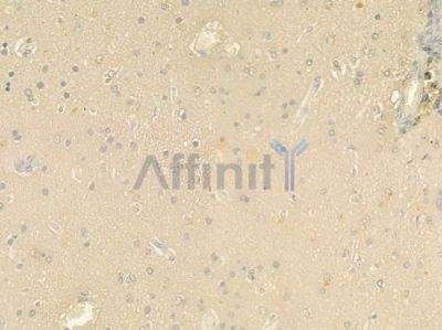 CTSS Antibody - DF8246 at 1/100 staining human glioblastoma by IHC-P.