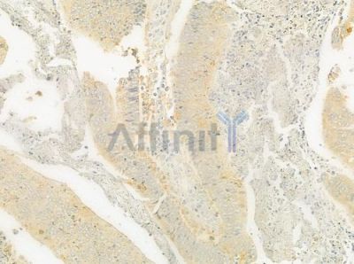 OS9 Antibody - DF8249 at 1/100 staining human colon carcinoma by IHC-P.