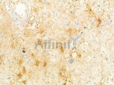 GCS alpha-1 Antibody - DF8551 at 1/100 staining human astrocytoma by IHC-P.