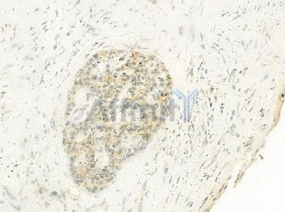IL-20R alpha Antibody - DF8565 at 1/100 staining human cervical carcinoma by IHC-P.