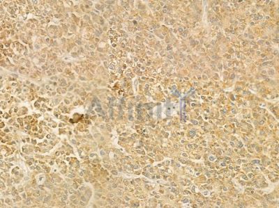 SLC22A6 Antibody - DF8582 at 1/100 staining human hepatocellular carcinoma by IHC-P.