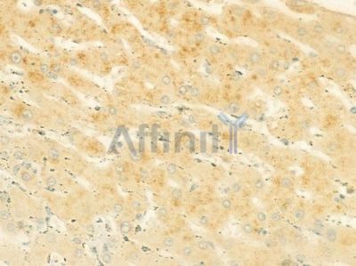Sarcoglycan beta Antibody - DF8605 at 1/100 staining human hepatocellular carcinoma by IHC-P.