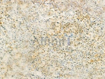 SEMA3C Antibody - DF8610 at 1/100 staining human colon carcinoma by IHC-P.