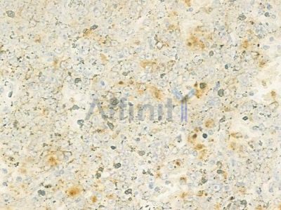 GAS6 Antibody - DF8659 at 1/100 staining human melanoma by IHC-P.