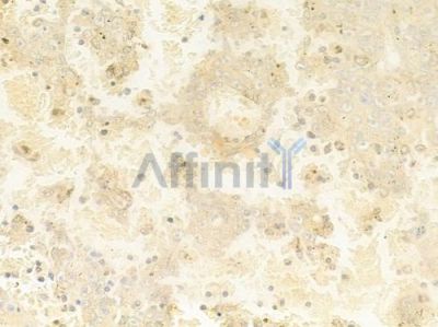 NOL8 Antibody - DF8683 at 1/100 staining human melanoma by IHC-P.