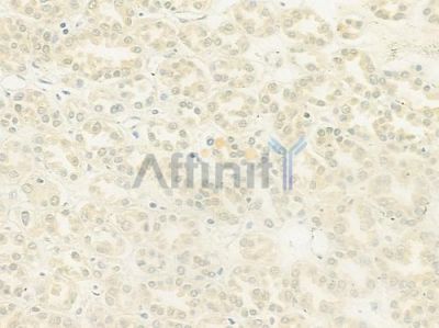 NOL8 Antibody - DF8683 at 1/100 staining human renal cell carcinoma by IHC-P.