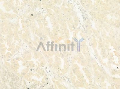 TMPRSS3 Antibody - DF8730 at 1/100 staining human renal cell carcinoma by IHC-P.
