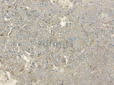 Phospho-MEKK1 (Thr1402)[Thr1400] Antibody - DF8741 at 1/100 staining human melanoma by IHC-P.