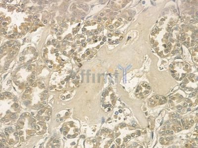 Phospho-OSR1 (Thr185) Antibody - DF8742 at 1/100 staining human renal cell carcinoma by IHC-P.