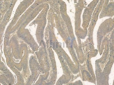 Phospho-OSR1 (Thr185) Antibody - DF8742 at 1/100 staining human colon carcinoma by IHC-P.
