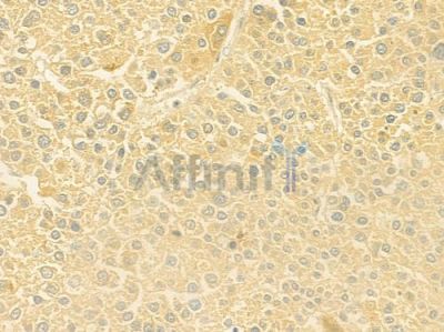 COX5B Antibody - DF8908 at 1/100 staining human hepatocellular carcinoma by IHC-P.