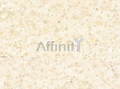 FGF11 Antibody - DF8944 at 1/100 staining human astrocytoma by IHC-P.