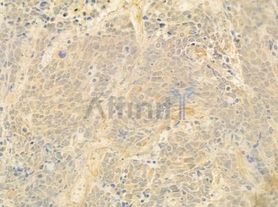 IL17B Antibody - DF8979 at 1/100 staining human small cell lung carcinoma by IHC-P.