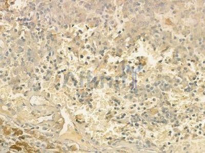 IL17F Antibody - DF8981 at 1/100 staining human melanoma by IHC-P.