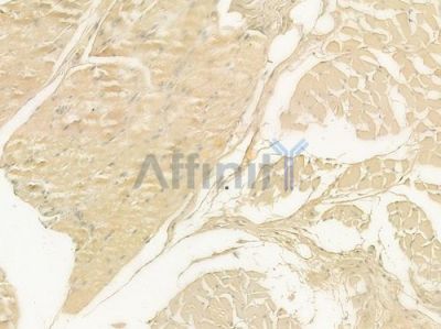 IL17F Antibody - DF8981 at 1/100 staining human tongue carcinoma by IHC-P.