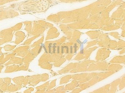 IL28B Antibody - DF8984 at 1/100 staining human tongue carcinoma by IHC-P.