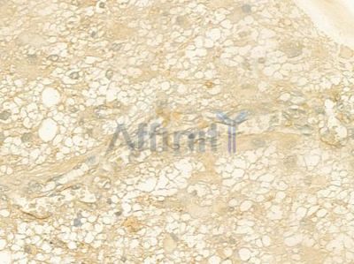 IL3 Antibody - DF8985 at 1/100 staining human astrocytoma by IHC-P.