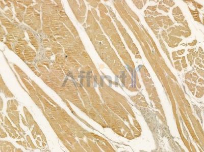 Keratin 23 Antibody - DF9000 at 1/100 staining human tongue carcinoma by IHC-P.