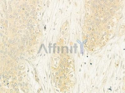 K2C3 Antibody - DF9010 at 1/100 staining human cervical carcinoma by IHC-P.