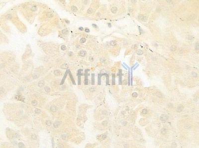 POU5F2 Antibody - DF9089 at 1/100 staining human renal cell carcinoma by IHC-P.