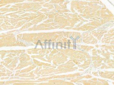 MRPL28 Antibody - DF9105 at 1/100 staining human tongue carcinoma by IHC-P.