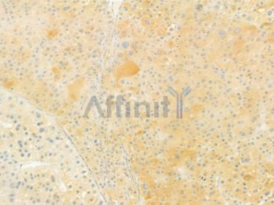 MRPL28 Antibody - DF9105 at 1/100 staining human hepatocellular carcinoma by IHC-P.