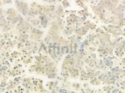 RPL18A Antibody - DF9127 at 1/100 staining human melanoma by IHC-P.