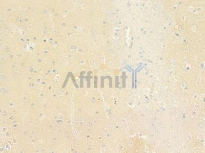 RPL24 Antibody - DF9128 at 1/100 staining human glioblastoma by IHC-P.