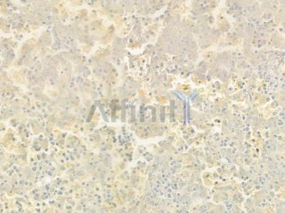 ABLIM1 Antibody - DF9145 at 1/100 staining human melanoma by IHC-P.
