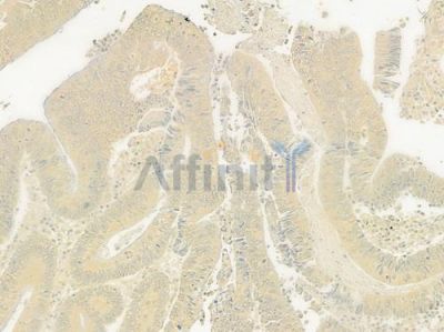 ADAMDEC1 Antibody - DF9167 at 1/100 staining human colon carcinoma by IHC-P.