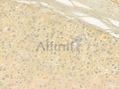 ADAMTS13 Antibody - DF9171 at 1/100 staining human hepatocellular carcinoma by IHC-P.