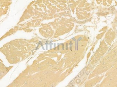 ADAMTS14 Antibody - DF9172 at 1/100 staining human tongue carcinoma by IHC-P.