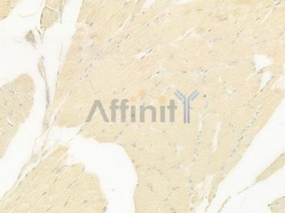 AGXT2 Antibody - DF9184 at 1/100 staining human tongue carcinoma by IHC-P.