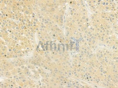 AKR1C4 Antibody - DF9190 at 1/100 staining human hepatocellular carcinoma by IHC-P.