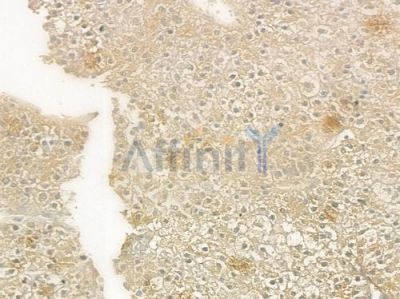 SERPINF2 Antibody - DF9194 at 1/100 staining human hepatocellular carcinoma by IHC-P.