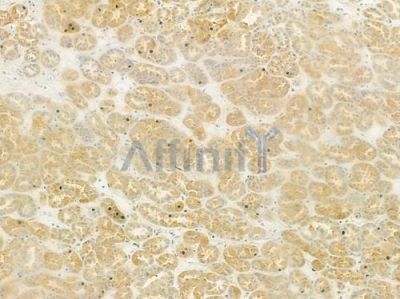 CTNNAL1 Antibody - DF9195 at 1/100 staining human renal cell carcinoma by IHC-P.