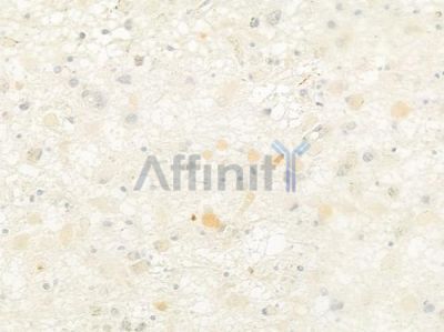 APBA2 Antibody - DF9203 at 1/100 staining human astrocytoma by IHC-P.