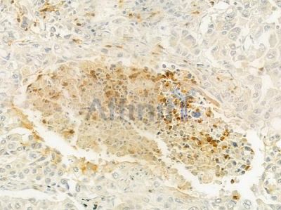 APOL5 Antibody - DF9218 at 1/100 staining human lung squamous cell carcinoma by IHC-P.