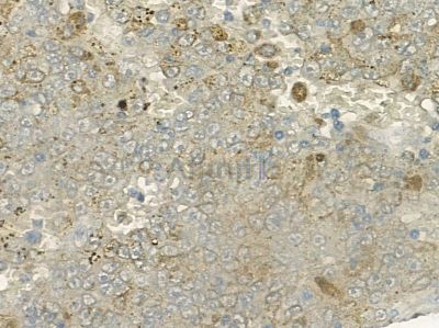 ATP5E Antibody - DF9238 at 1/100 staining human liver cancer by IHC-P.
