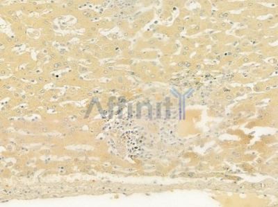 ABCC8 Antibody - DF9254 at 1/100 staining human hepatocellular carcinoma by IHC-P.