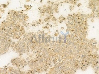 ABCC9 Antibody - DF9255 at 1/100 staining human melanoma by IHC-P.