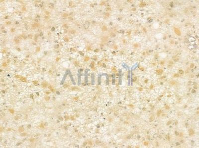 PIF1 Antibody - DF9256 at 1/100 staining human astrocytoma by IHC-P.