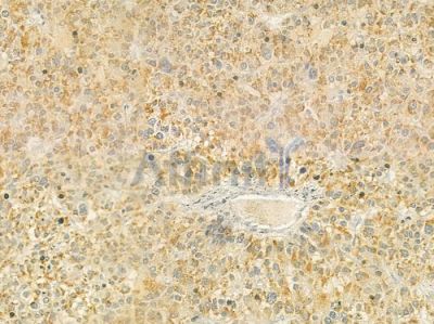 BAAT Antibody - DF9277 at 1/100 staining human hepatocellular carcinoma by IHC-P.