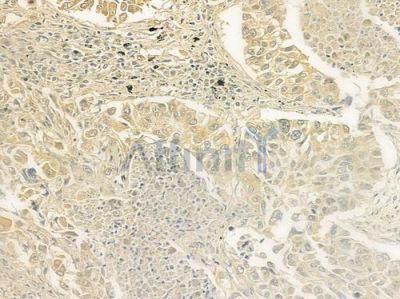 BRI3 Antibody - DF9284 at 1/100 staining human lung squamous cell carcinoma by IHC-P.