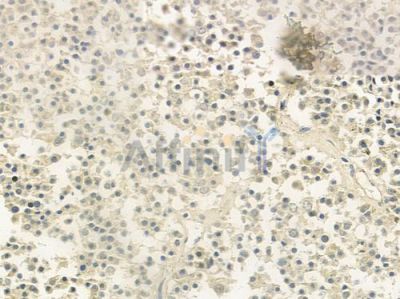 CABIN1 Antibody - DF9294 at 1/100 staining human pituitary adenoma by IHC-P.
