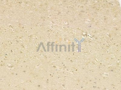 CAPN6 Antibody - DF9321 at 1/100 staining human glioblastoma by IHC-P.