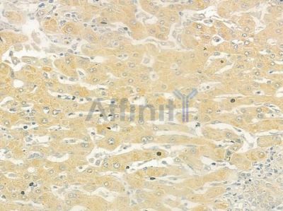 CHST12 Antibody - DF9328 at 1/100 staining human hepatocellular carcinoma by IHC-P.